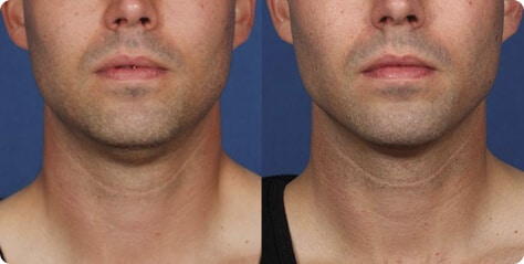 Before-and-After-Kybella-1