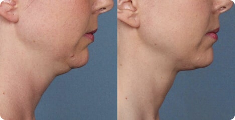 Before-and-After-Kybella-2