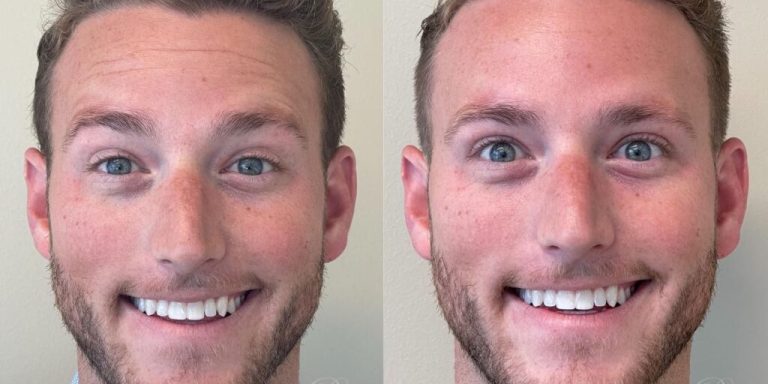 male-before-after-botox-forehead-treatment-1024x683